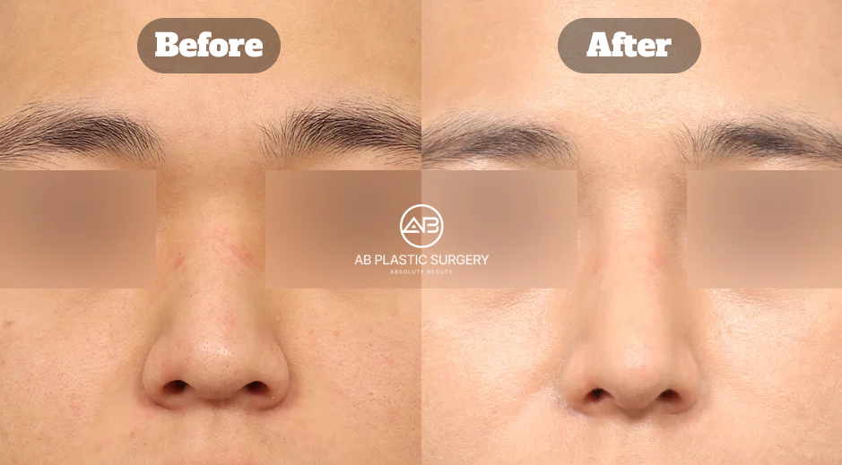 Perbandingan sebelum dan sesudah operasi hidung bengkok pada pria dengan koreksi hidung bulbous dan fungsi di Operasi Plastik AB Korea