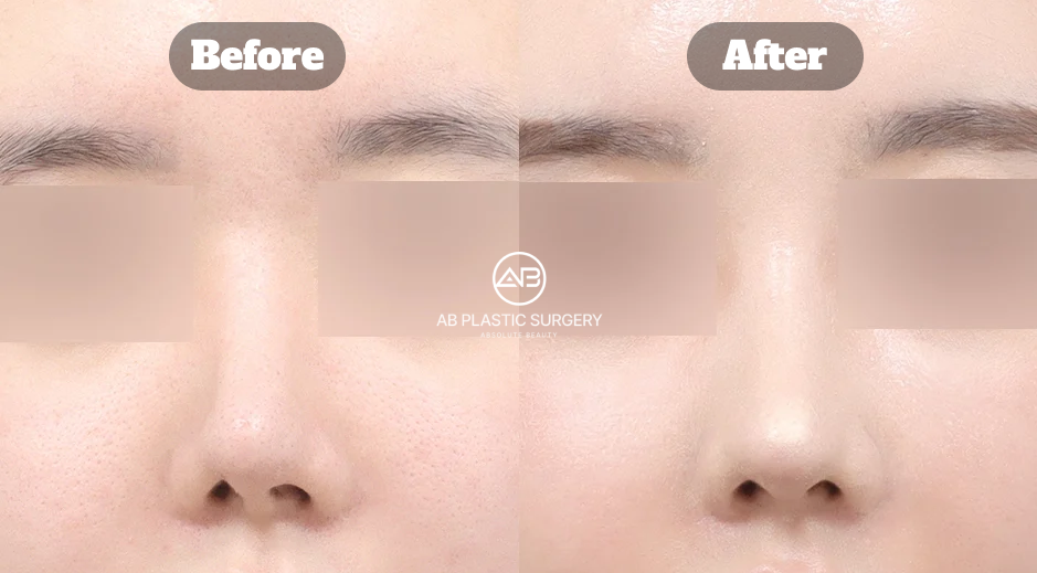 Hasil sebelum dan sesudah koreksi hidung bengkok dengan perpanjangan hidung pendek dan peningkatan proporsi wajah di Operasi Plastik AB Korea