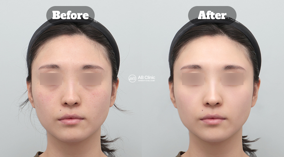 hasil sebelum dan sesudah perawatan wajah di Korea dengan skin booster seperti Elravie untuk meningkatkan hidrasi kulit, mencerahkan warna kulit, dan menghasilkan tampilan lebih halus alami