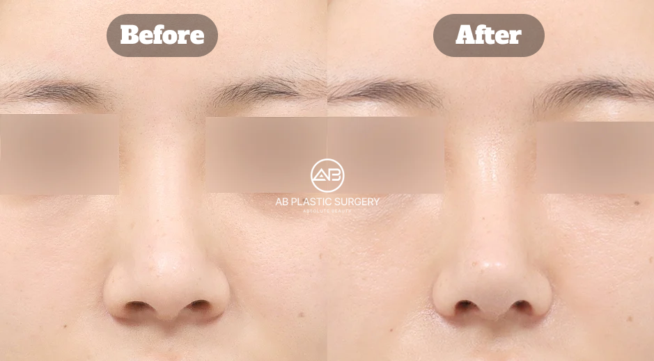 Perbandingan sebelum dan sesudah revisi hidung bengkok dengan alar reduction, peningkatan simetri, dan koreksi fungsi di Operasi Plastik AB Korea
