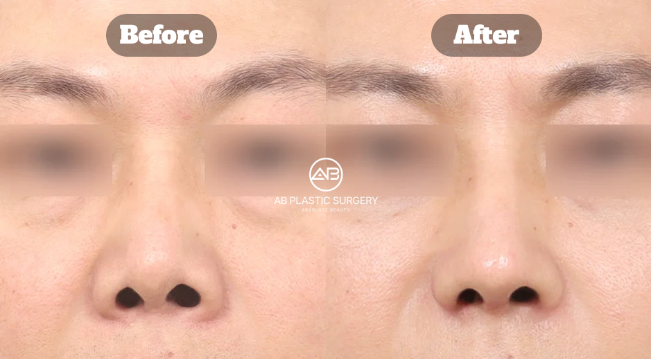 Hasil sebelum dan sesudah revisi hidung bengkok dengan perbaikan struktur bawah hidung, alar reduction, dan peningkatan aliran napas di Operasi Plastik AB Korea