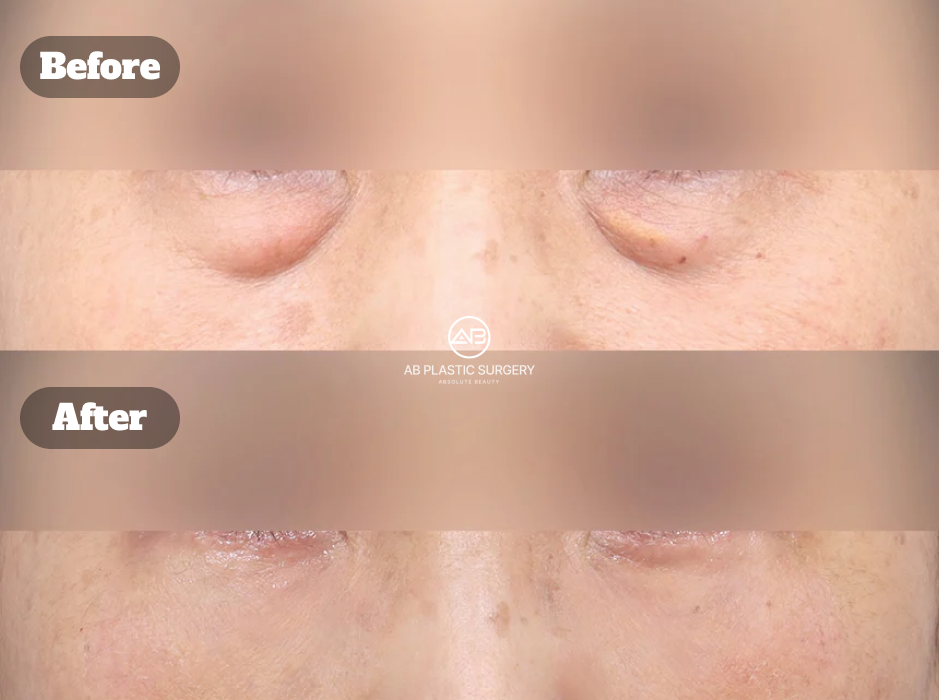 Hasil Before After Lower Blepharoplasty untuk Menghilangkan Kantung Mata Besar dan Mata Panda Secara Signifikan di Korea