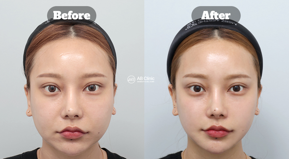 Before and After Ultherapy Showing Improved Facial Symmetry, Reduced Smile Lines, and Firmer Skin in Korea