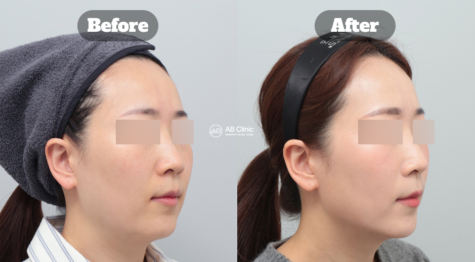 Before and After Ultherapy Showing Smoother Smile Lines, Lifted Facial Profile, and Improved Skin Firmness in Korea