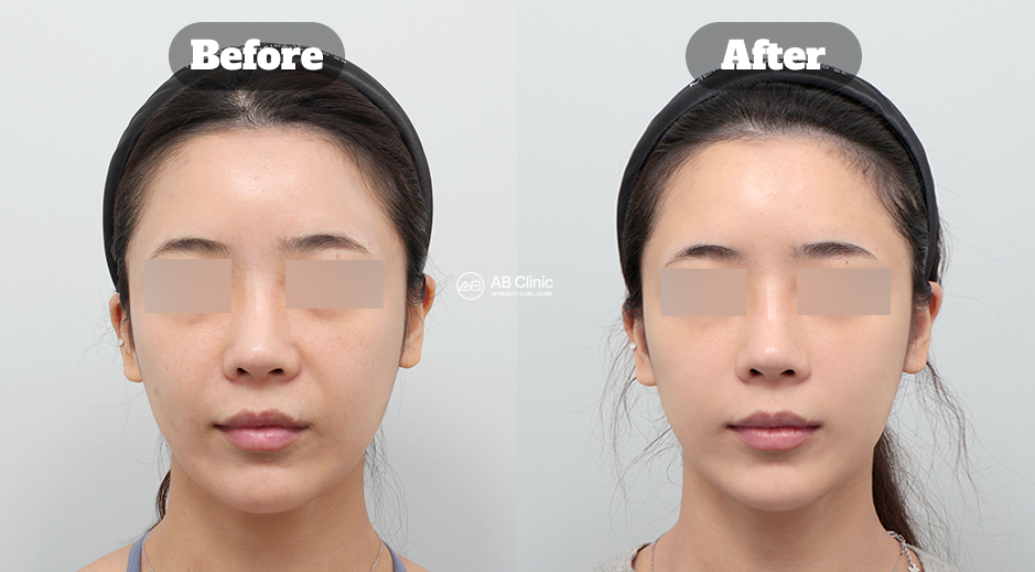 Before and After Ultherapy Showing Reduced Smile Lines, More Even Skin Tone, and Refreshed Facial Appearance in Korea