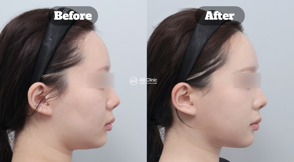 Perubahan Sebelum Sesudah Ultherapy dalam Membentuk Wajah Lebih Kecil dan Meningkatkan Definisi Jawline Tanpa Operasi