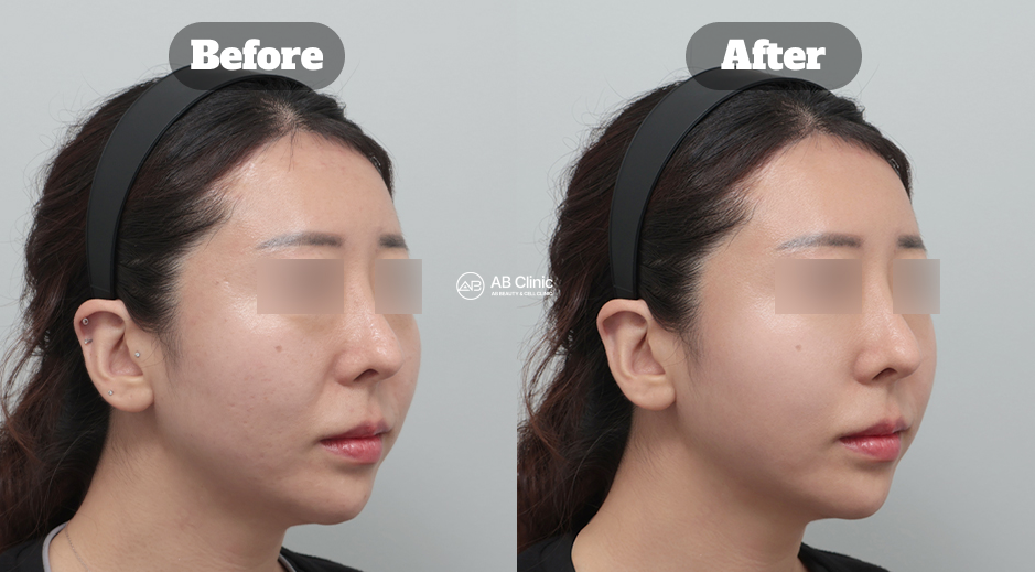 Before and After Skin Treatment Showing Reduced Smile Lines, Minimized Pores, and Clearer, Smoother Skin in Korea