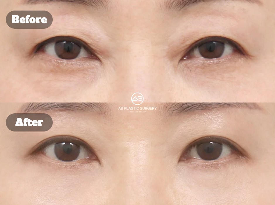 Before After Revisi Kombinasi Brow Lift dan Lower Blepharoplasty untuk Menghilangkan Kantung Mata dan Mata Panda Secara Alami di Korea