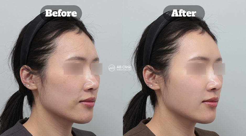 Before and After Skin Treatment Results Showing Reduced Smile Lines and Smoother Facial Texture in Korea