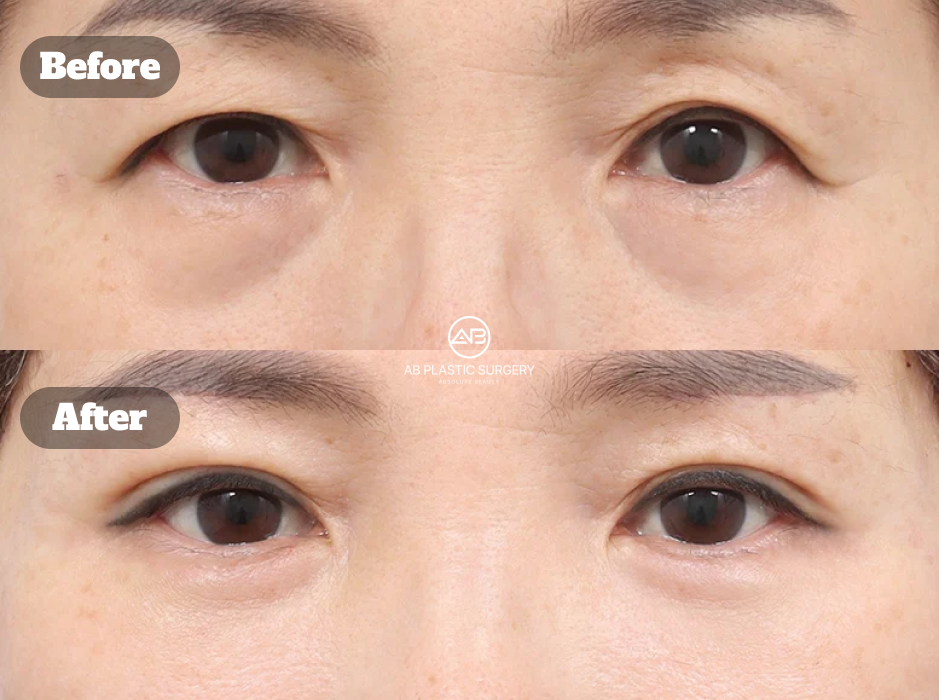 Before After Kombinasi Upper Blepharoplasty, Lower Blepharoplasty, Double Eyelid, dan Brow Lift untuk Menghilangkan Kantung Mata dan Mata Panda di Korea