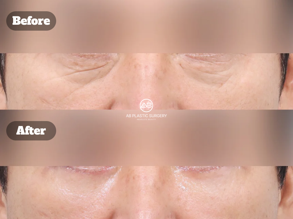 Before After Lower Blepharoplasty untuk Menghilangkan Kantung Mata, Mata Panda, dan Kerutan Bawah Mata pada Pria di Korea