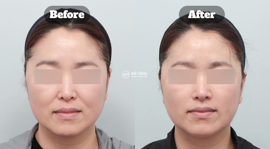 Before and After Lifting Treatment Showing Reduced Smile Lines and Firmer Facial Contour Using Ultrasound Devices in Korea