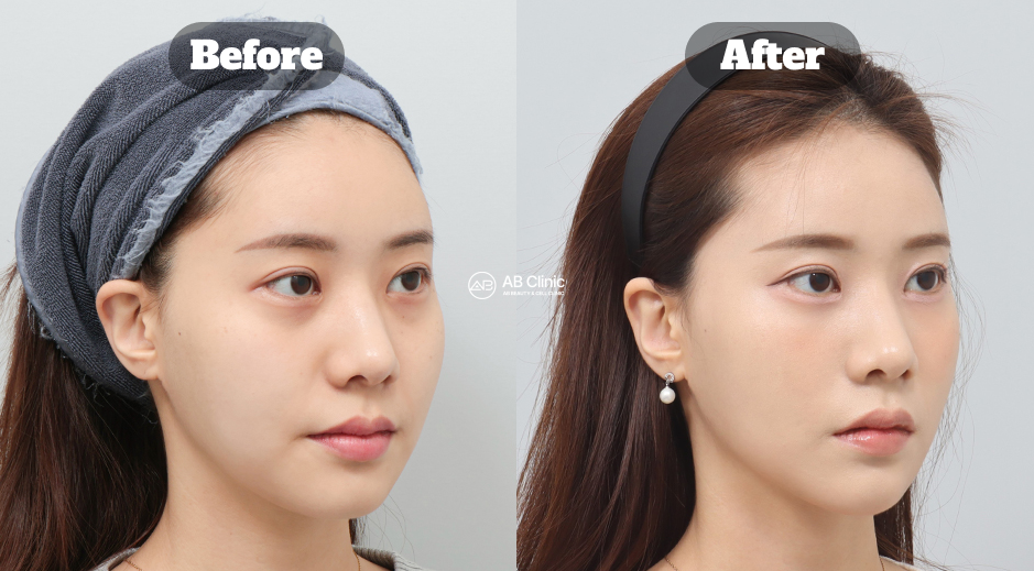 Before and After Facial Treatment Showing Smoother Smile Lines and Enhanced Jawline Contour with Lifting and Filler in Korea