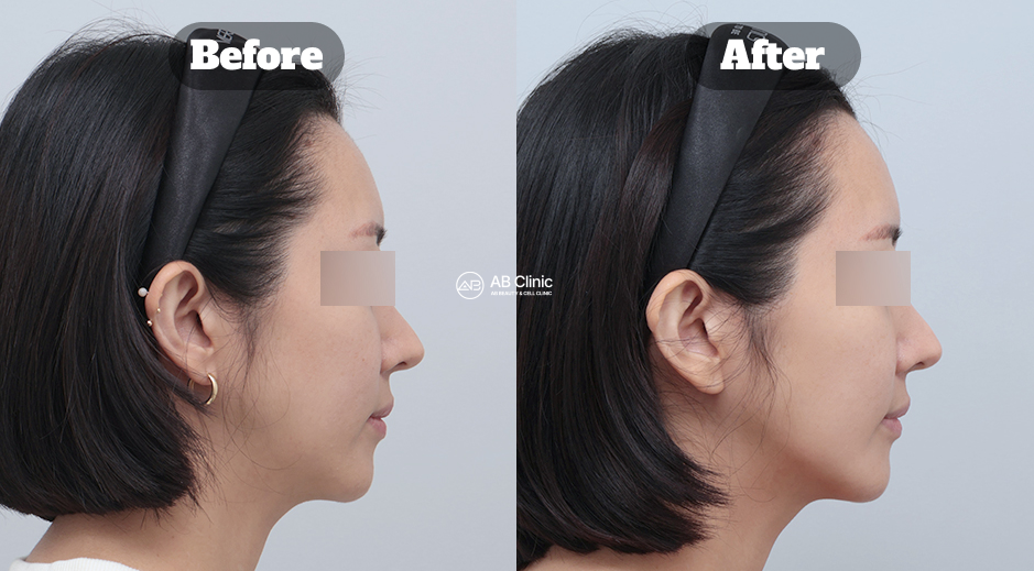 Perbandingan Sebelum Sesudah Thermage dalam Meningkatkan Elastisitas Kulit dan Membentuk Kontur Wajah Samping Lebih Tegas