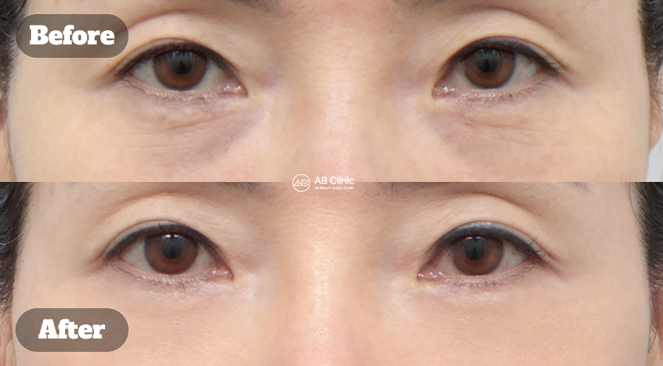 Hasil Before After Juvelook Eye Treatment di Korea untuk Mengurangi Mata Panda dan Menghilangkan Kantung Mata Secara Alami
