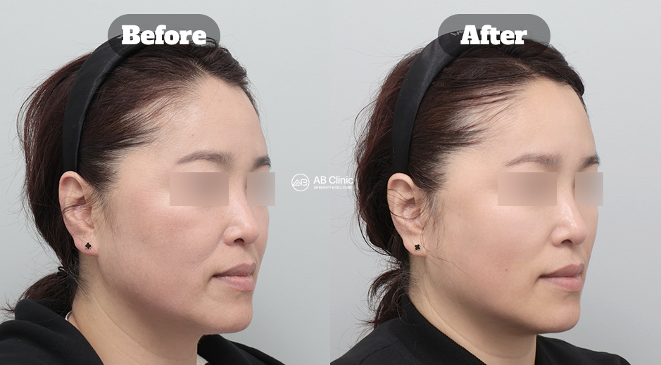 Before and After Thread Lifting Showing Lifted Midface and Reduced Smile Lines with Natural Anti Aging Effect in Korea