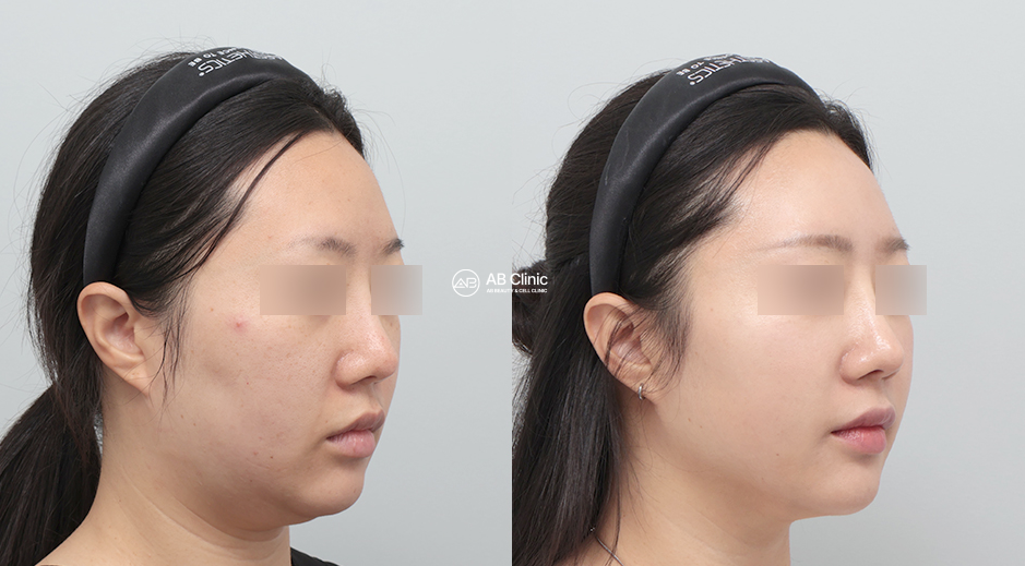 Perubahan Sebelum Sesudah Ultherapy dengan Stem Cell Skin Injection dalam Meningkatkan Kualitas Kulit dan Memperbaiki Kontur Wajah