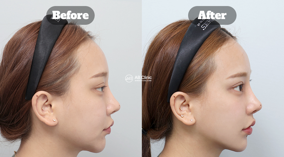 Perbandingan Sebelum Sesudah Ultherapy dalam Mengangkat Kulit Wajah dan Memperbaiki Kontur Rahang Secara Natural