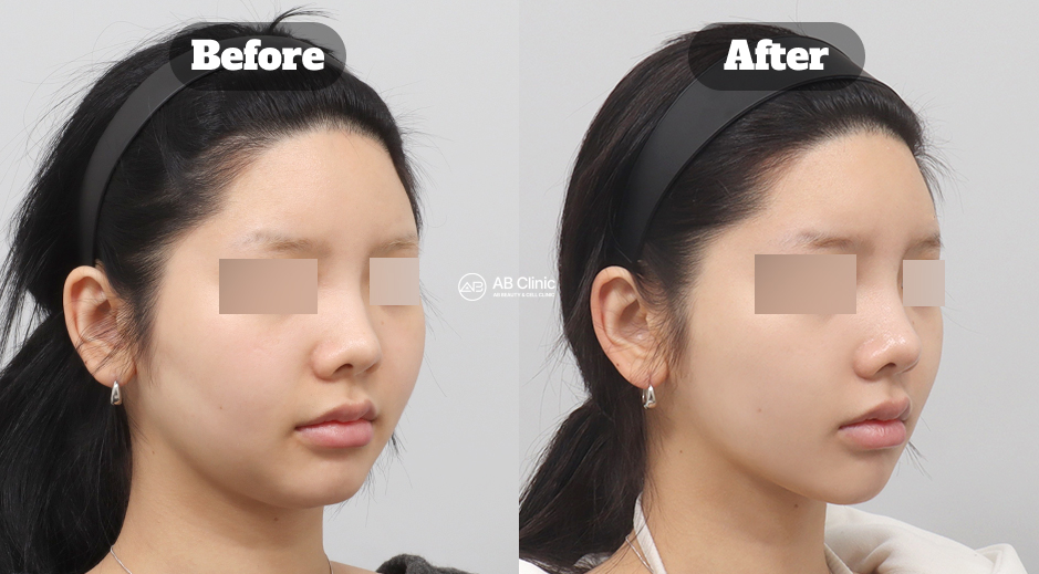 Before and After Ultherapy Face Slimming Showing Reduced Smile Lines and More Defined Facial Contour in Korea