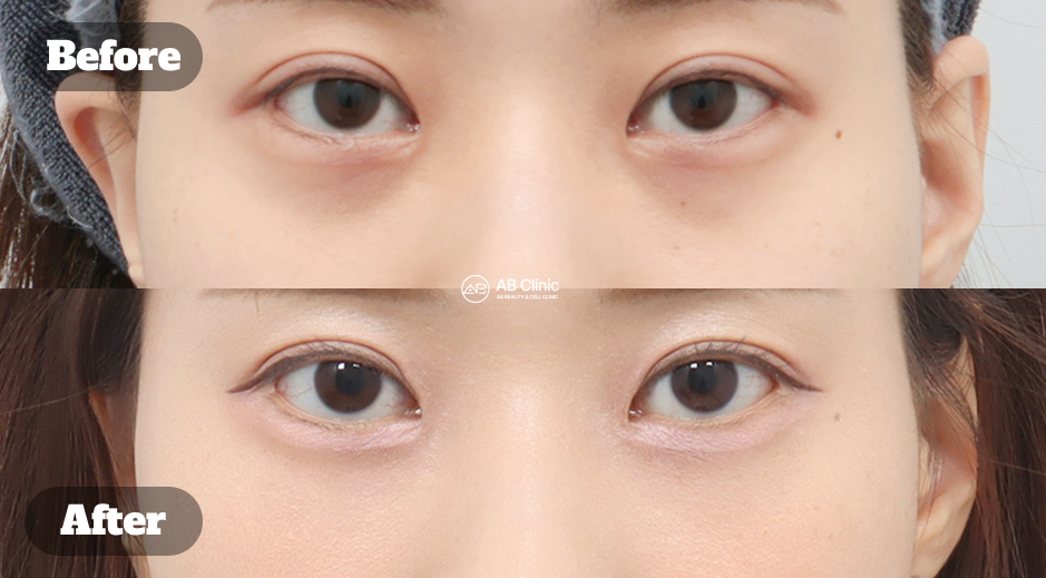 Hasil Before After Filler Bawah Mata di Korea untuk Mengurangi Mata Panda dan Menyamarkan Kantung Mata Secara Natural