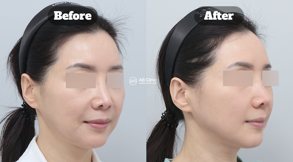 Before and After Thread Lift Showing Lifted Cheeks, Reduced Smile Lines, and Smoother Midface Contour in Korea