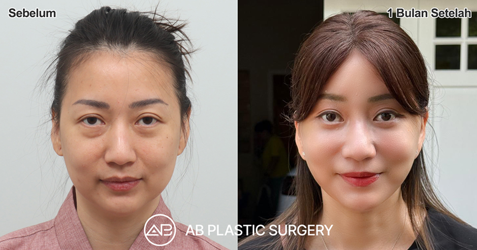 Before after facelift Korea Nana Koot dengan garis rahang lebih tegas dan hasil natural