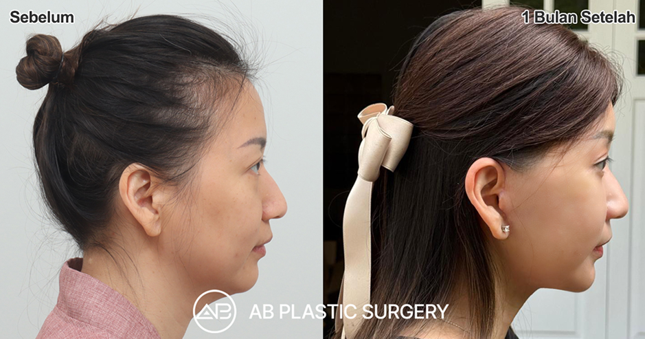 Before after facelift Korea dan operasi kantung mata Nana Koot dengan hasil natural
