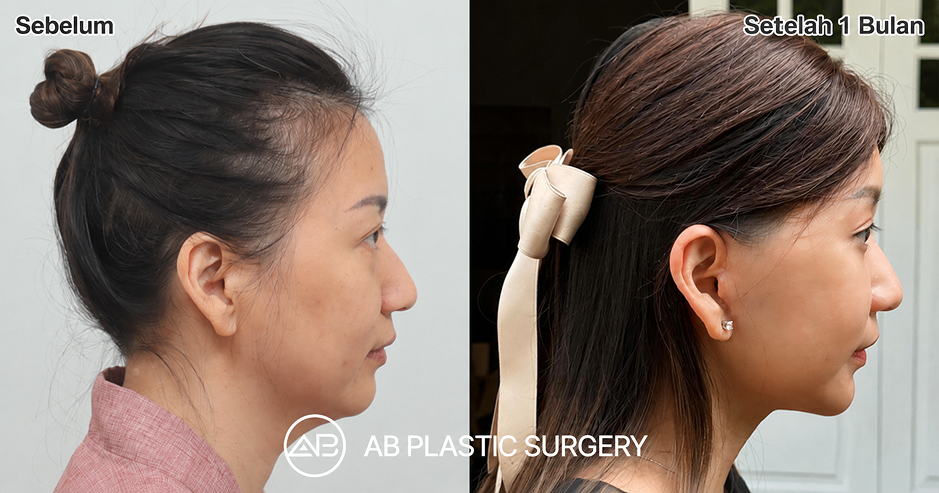 Sebelum dan Sesudah facelift Korea dan operasi kantung mata Nana Koot dengan hasil natural