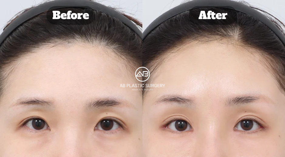 Hasil Brow Lift dan Eye Opening Surgery di Operasi Plastik AB Korea Secara Natural