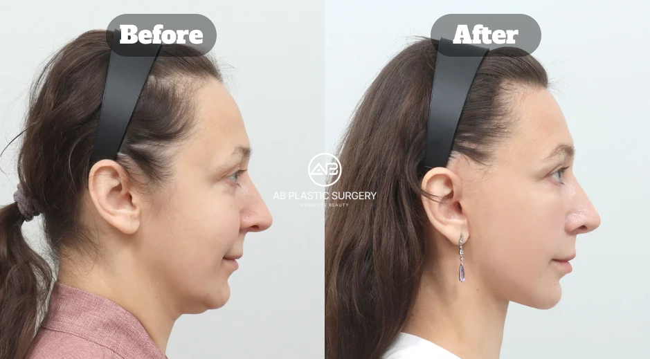 Perubahan profil samping setelah facelift Korea di Operasi Plastik AB