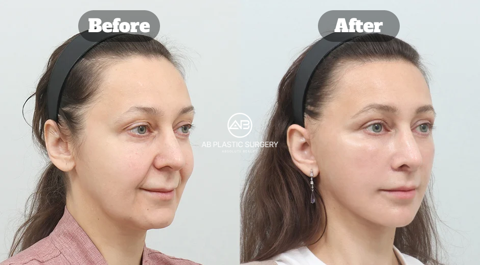Efek wajah lebih muda setelah SMAS facelift Korea di Operasi Plastik AB