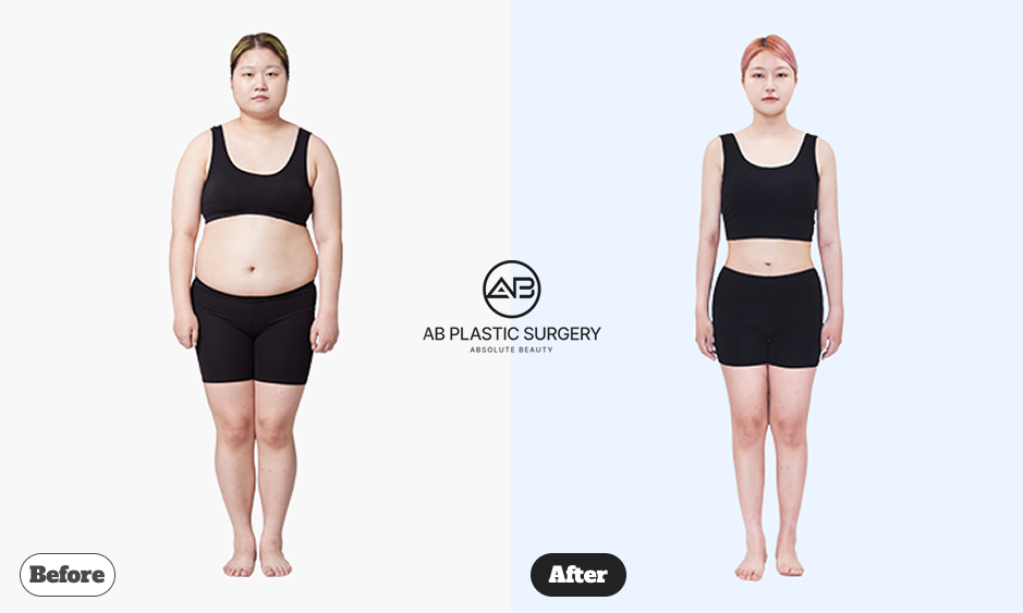 Hasil Body Contouring Pinggang Natural di Operasi Plastik AB Korea