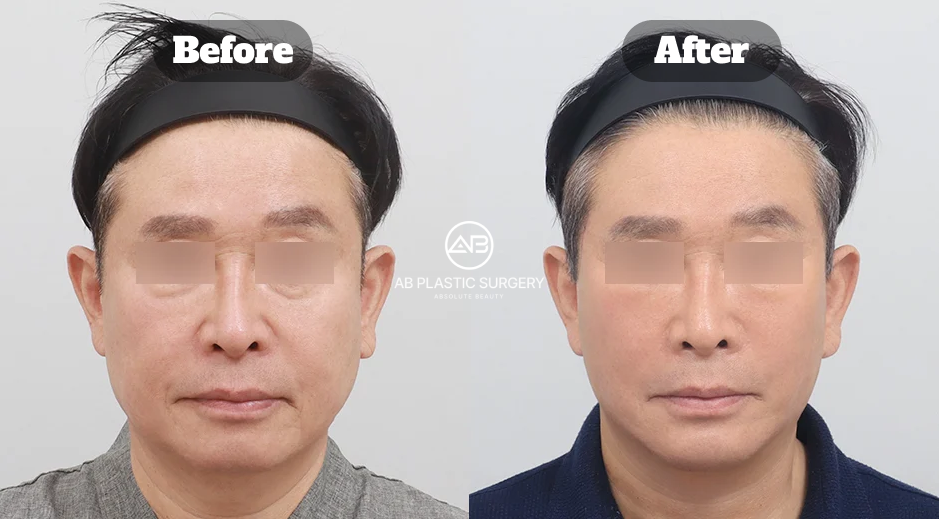 Perubahan natural pria setelah facelift Korea di Operasi Plastik AB