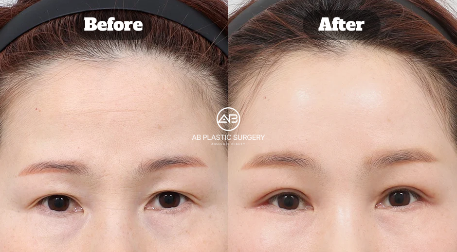 Hasil Brow Lift dan Revisi Upper Blepharoplasty di Operasi Plastik AB Korea
