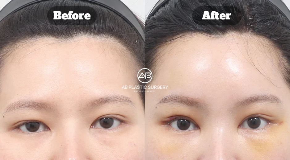 Hasil Brow Lift Korea di Operasi Plastik AB untuk Membuat Mata Terlihat Lebih Terbuka