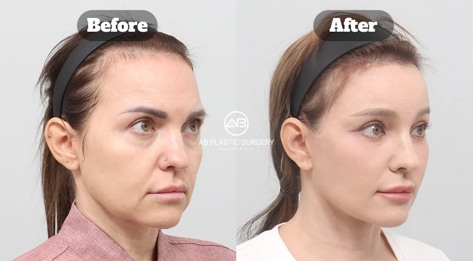 Efek anti aging natural setelah SMAS facelift Korea di Operasi Plastik AB