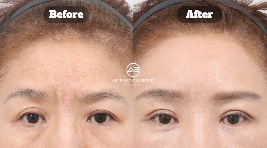 Hasil Brow Lift dan Upper Lower Blepharoplasty di Operasi Plastik AB Korea