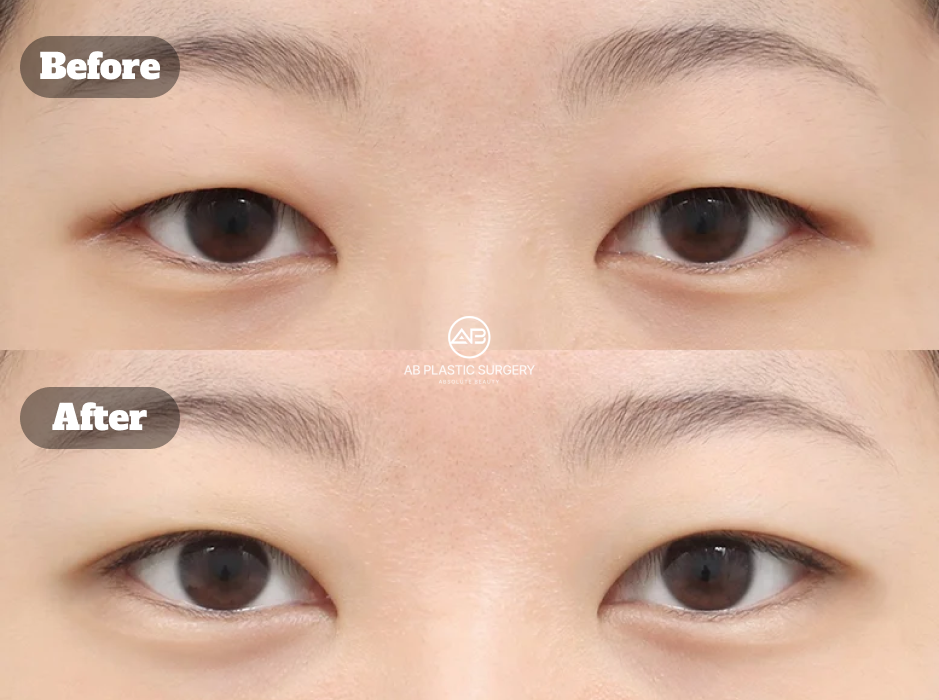 Perbandingan Mata Monolid dengan Kelopak Berat Sebelum dan Sesudah Koreksi Ptosis Non-Insisi serta Pengangkatan Lemak Kelopak Setelah 1 Bulan di Operasi Plastik AB Korea