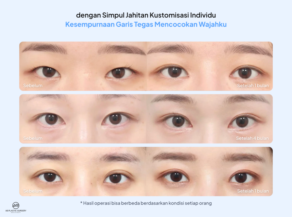 Hasil Operasi Kelopak Mata Ganda dengan Desain Garis yang Dipersonalisasi Berdasarkan Bentuk Mata di Operasi Plastik AB Korea