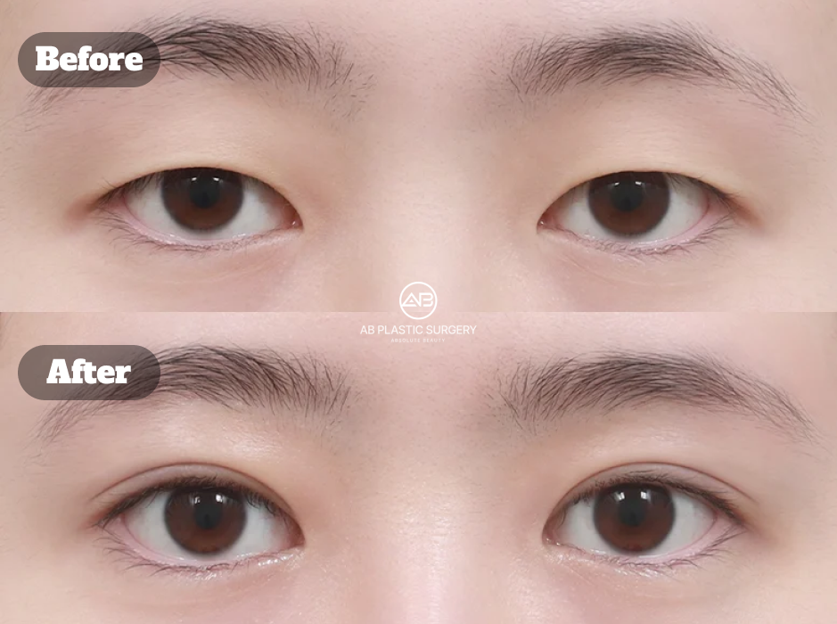 Perbandingan Mata Monolid Sebelum dan Sesudah Operasi Double Eyelid Non-Insisi pada Hari ke-7 di Operasi Plastik AB Korea Menunjukkan Tahap Awal Pemulihan