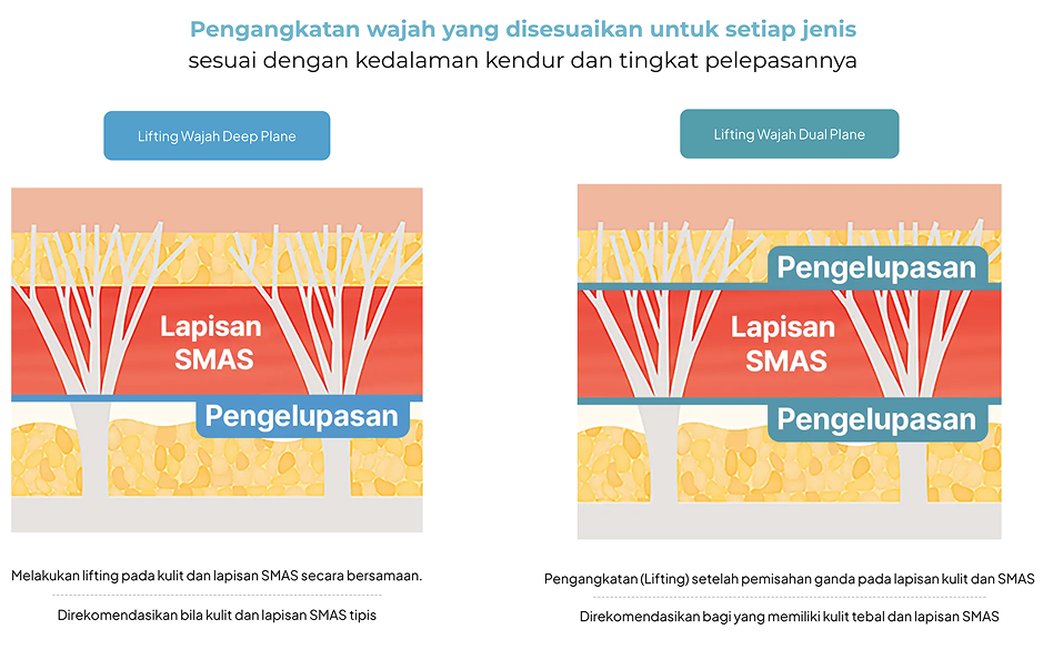 Diagram Perbandingan Lapisan SMAS pada Deep Plane Lift dan Dual Plane Facelift untuk Memahami Cara Kerja Facelift di Operasi Plastik AB Korea