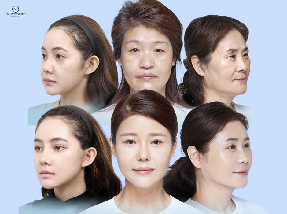 Ilustrasi Tahap Kekenduran Kulit dan Penuaan Wajah untuk Menentukan Kapan Memilih Ultherapy atau Facelift di Operasi Plastik AB Korea
