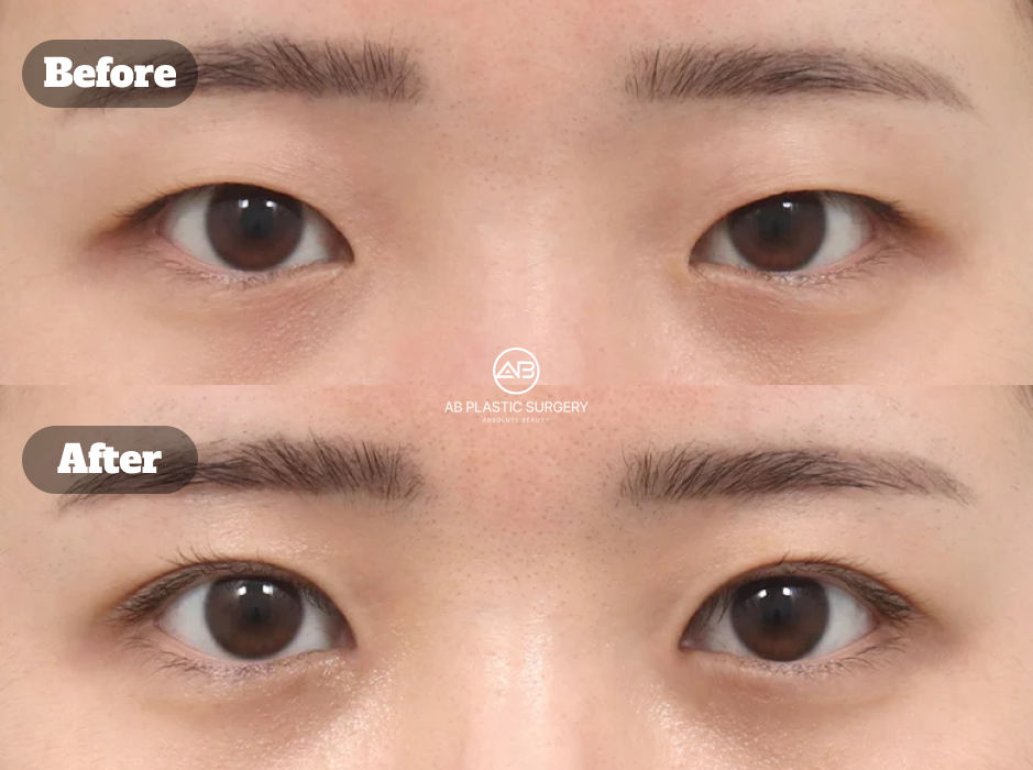 Hasil Mata Monolid Setelah Operasi Double Eyelid Non-Insisi dan Epicanthoplasty pada Hari ke-6 di Operasi Plastik AB Korea Menunjukkan Proses Pemulihan Awal