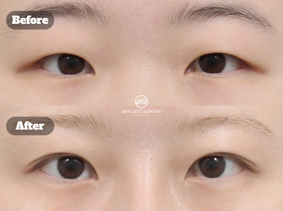 Perbandingan Mata Monolid Sebelum dan Sesudah Koreksi Ptosis Metode Insisi Selama 1 Bulan di Operasi Plastik AB Korea dengan Hasil Natural
