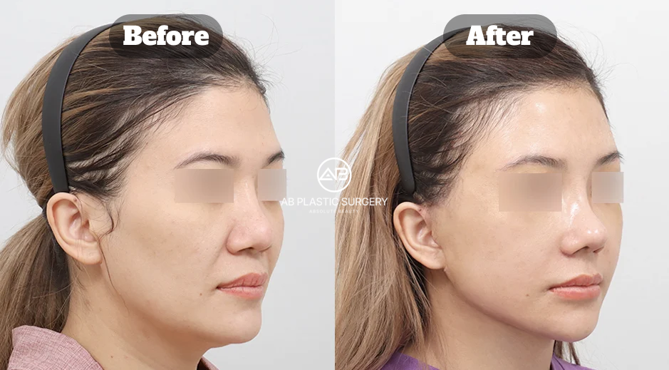 Perbandingan Sebelum dan Sesudah Terapi Stem Cell di Operasi Plastik AB Korea dari Sudut Samping yang Menunjukkan Regenerasi Wajah, Peningkatan Kontur, dan Efek Anti-Aging Alami