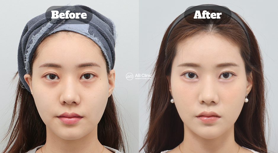 Perbandingan Hasil Ultherapy, Shurink, dan Filler Rahang di ABDermatologi sebagai Contoh Perawatan Lifting Wajah Non-Bedah Dibanding HIFU