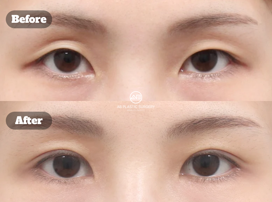 Hasil Mata Monolid Setelah Operasi Double Eyelid Non-Insisi dengan Tampilan Natural pada Hari ke-7 di Operasi Plastik AB Korea