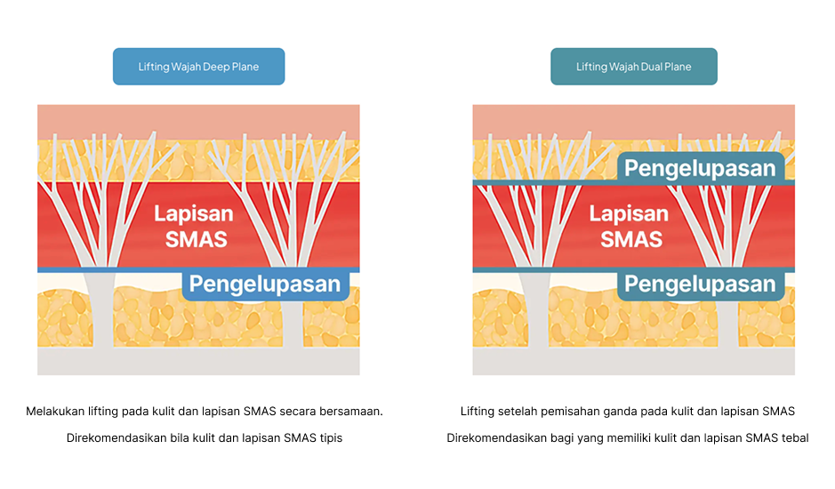 Ilustrasi Lapisan SMAS pada Deep Plane Lift dan Dual Plane Facelift di Operasi Plastik AB Korea