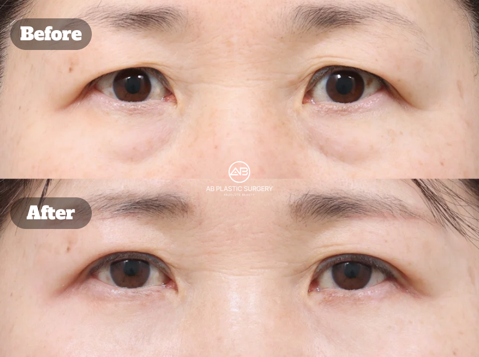 Hasil satu bulan setelah upper blepharoplasty, metode jahitan lipatan mata, dan sub-brow lift pada pasien lanjut usia.