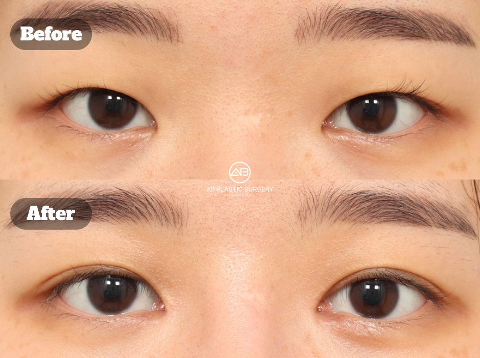 Foto sebelum dan sesudah koreksi ptosis non-insisi serta epikantoplasti yang memperjelas lipatan dan sudut dalam mata.